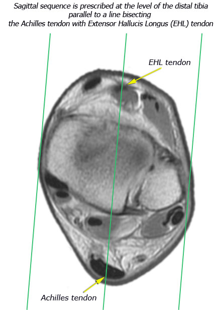 Ankle Sag Rx